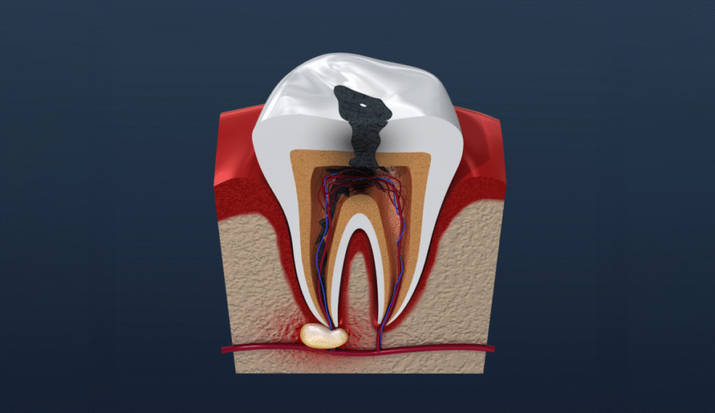 Endodonti (Kanal Tedavisi)